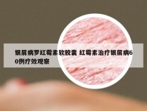 银屑病罗红霉素软胶囊 红霉素治疗银屑病60例疗效观察