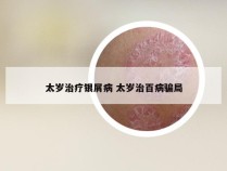 太岁治疗银屑病 太岁治百病骗局