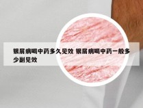 银屑病喝中药多久见效 银屑病喝中药一般多少副见效