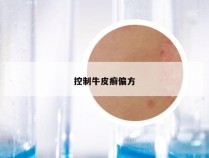 控制牛皮癣偏方
