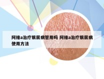 阿维a治疗银屑病管用吗 阿维a治疗银屑病使用方法