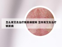 怎么用艾灸治疗银屑病视频 怎样用艾灸治疗银屑病