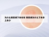 为什么银屑病下体也有 银屑病为什么下身多上身少
