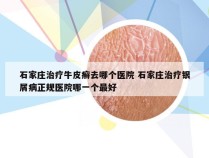 石家庄治疗牛皮癣去哪个医院 石家庄治疗银屑病正规医院哪一个最好