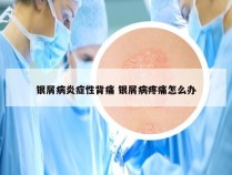 银屑病炎症性背痛 银屑病疼痛怎么办
