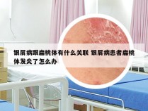 银屑病跟扁桃体有什么关联 银屑病患者扁桃体发炎了怎么办