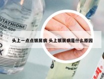 头上一点点银屑病 头上银屑病是什么原因