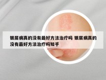 银屑病真的没有最好方法治疗吗 银屑病真的没有最好方法治疗吗知乎