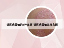 银屑病最怕的3种东西 银屑病最怕三样东西