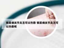 银屑病关节炎怎可以热敷 银屑病关节炎怎可以热敷呢