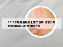2019年银屑病新药上市了没有 国家公布的银屑病新药什么时候上市