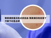 银屑病但是没有点状出血 银屑病没有皮屑了只剩下红色丘疹