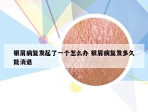 银屑病复发起了一个怎么办 银屑病复发多久能消退