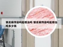 银皮癣传染吗能根治吗 银皮癣传染吗能根治吗多少钱