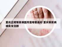 重庆正规银屑病医院是哪里最好 重庆银屑病病友交流群