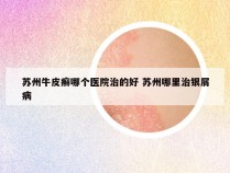 苏州牛皮癣哪个医院治的好 苏州哪里治银屑病