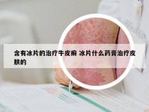 含有冰片的治疗牛皮癣 冰片什么药膏治疗皮肤的