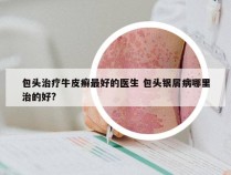 包头治疗牛皮癣最好的医生 包头银屑病哪里治的好?