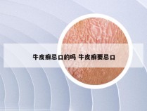牛皮癣忌口的吗 牛皮癣要忌口