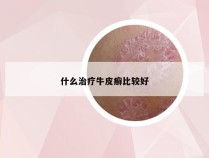 什么治疗牛皮癣比较好