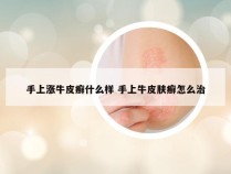 手上涨牛皮癣什么样 手上牛皮肤癣怎么治