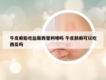 牛皮癣能吃盐酸西替利嗪吗 牛皮肤癣可以吃西瓜吗