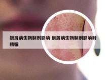 银屑病生物制剂影响 银屑病生物制剂影响射精嘛