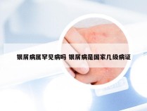 银屑病属罕见病吗 银屑病是国家几级病证