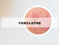 牛皮癣怎么治疗明星