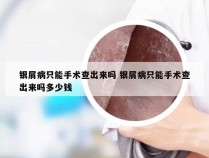 银屑病只能手术查出来吗 银屑病只能手术查出来吗多少钱