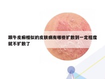 跟牛皮癣相似的皮肤病有哪些扩散到一定程度就不扩散了