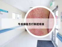 牛皮癣能否打新冠疫苗