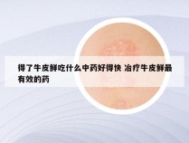 得了牛皮鲜吃什么中药好得快 冶疗牛皮鲜最有效的药