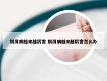 银屑病越来越厉害 银屑病越来越厉害怎么办