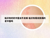 临沂有好的中医治牛皮癣 临沂有看皮肤病的老中医吗
