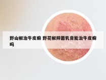 野山椒治牛皮癣 野花椒抑菌乳膏能治牛皮癣吗