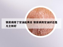 银屑病用了甘油起黄皮 银屑病用甘油好还是凡士林好