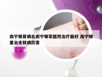 南宁银屑病去南宁哪家医院治疗最好 南宁哪里治皮肤病厉害