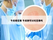 牛皮癣坚果 牛皮鲜可以吃坚果吗