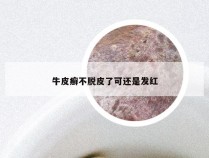 牛皮癣不脱皮了可还是发红