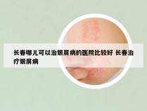 长春哪儿可以治银屑病的医院比较好 长春治疗银屑病