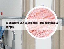 银屑病做椎间盘手术影响吗 银屑病影响手术切口吗