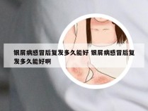 银屑病感冒后复发多久能好 银屑病感冒后复发多久能好啊