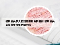 银屑病关节炎初期需要用生物制剂 银屑病关节炎需要打生物制剂吗