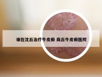 谁在沈丘治疗牛皮癣 商丘牛皮癣医院