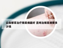 云南那家治疗银屑病最好 昆明治银屑病要多少钱
