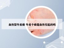 血热型牛皮癣 牛皮个癣是血热引起的吗