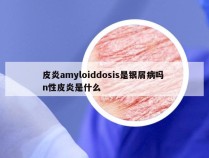 皮炎amyloiddosis是银屑病吗 n性皮炎是什么