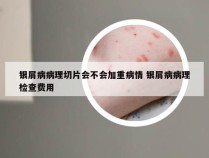银屑病病理切片会不会加重病情 银屑病病理检查费用