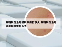 生物制剂治疗银屑病要打多久 生物制剂治疗银屑病需要打多久